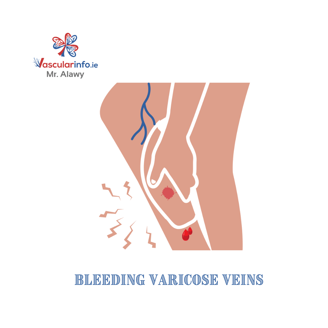 Varicose Veins & Venous Diseases