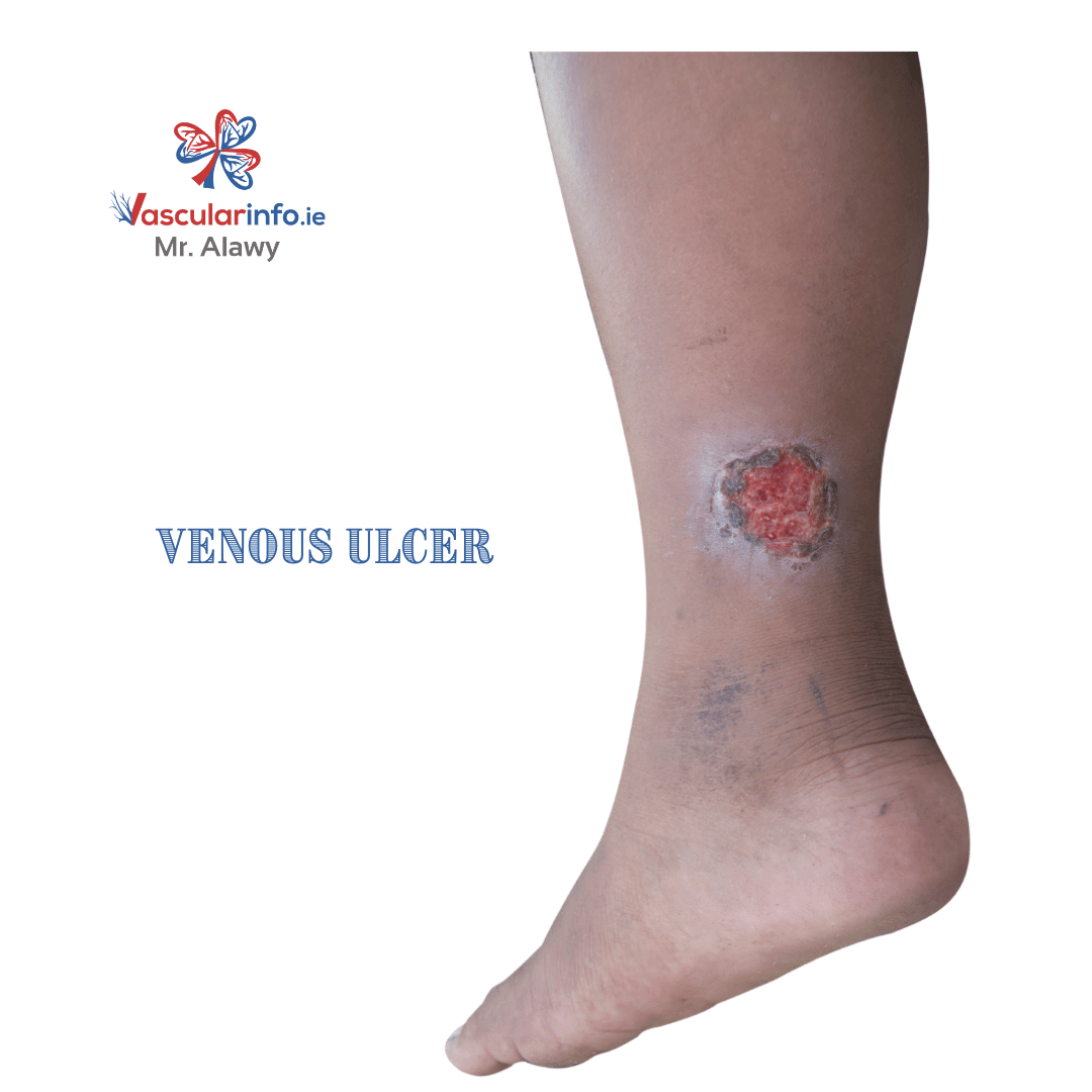 Varicose Veins & Venous Diseases