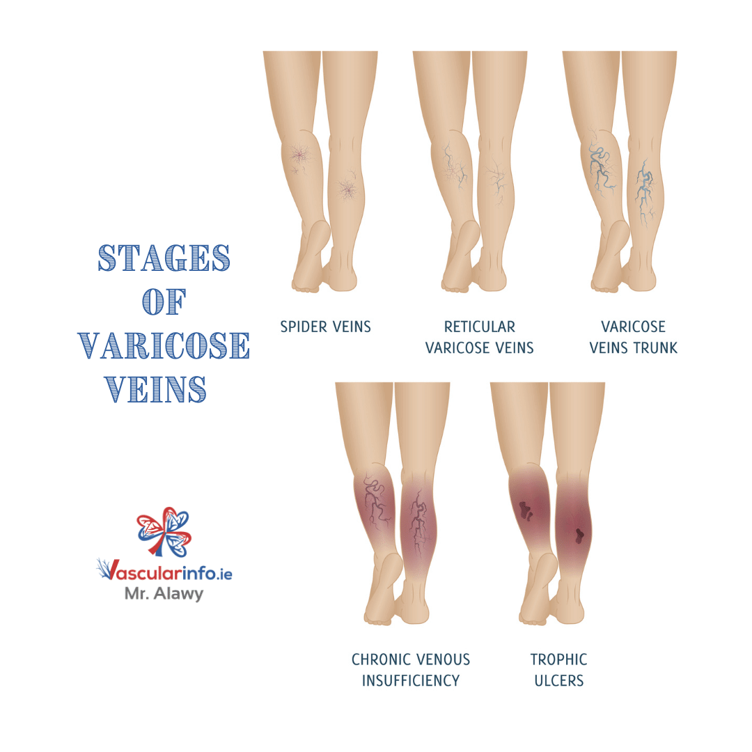 Varicose Veins & Venous Diseases