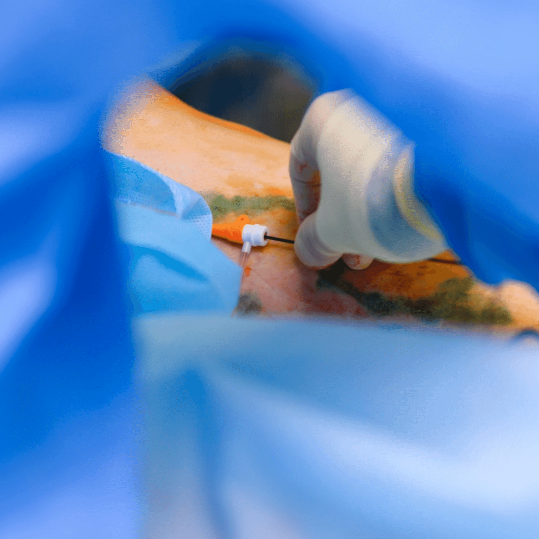 Varicose Veins & Venous Diseases