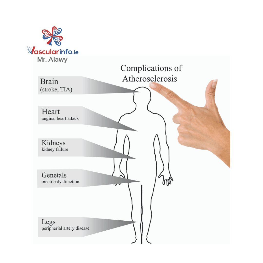 Arteriosclerosis