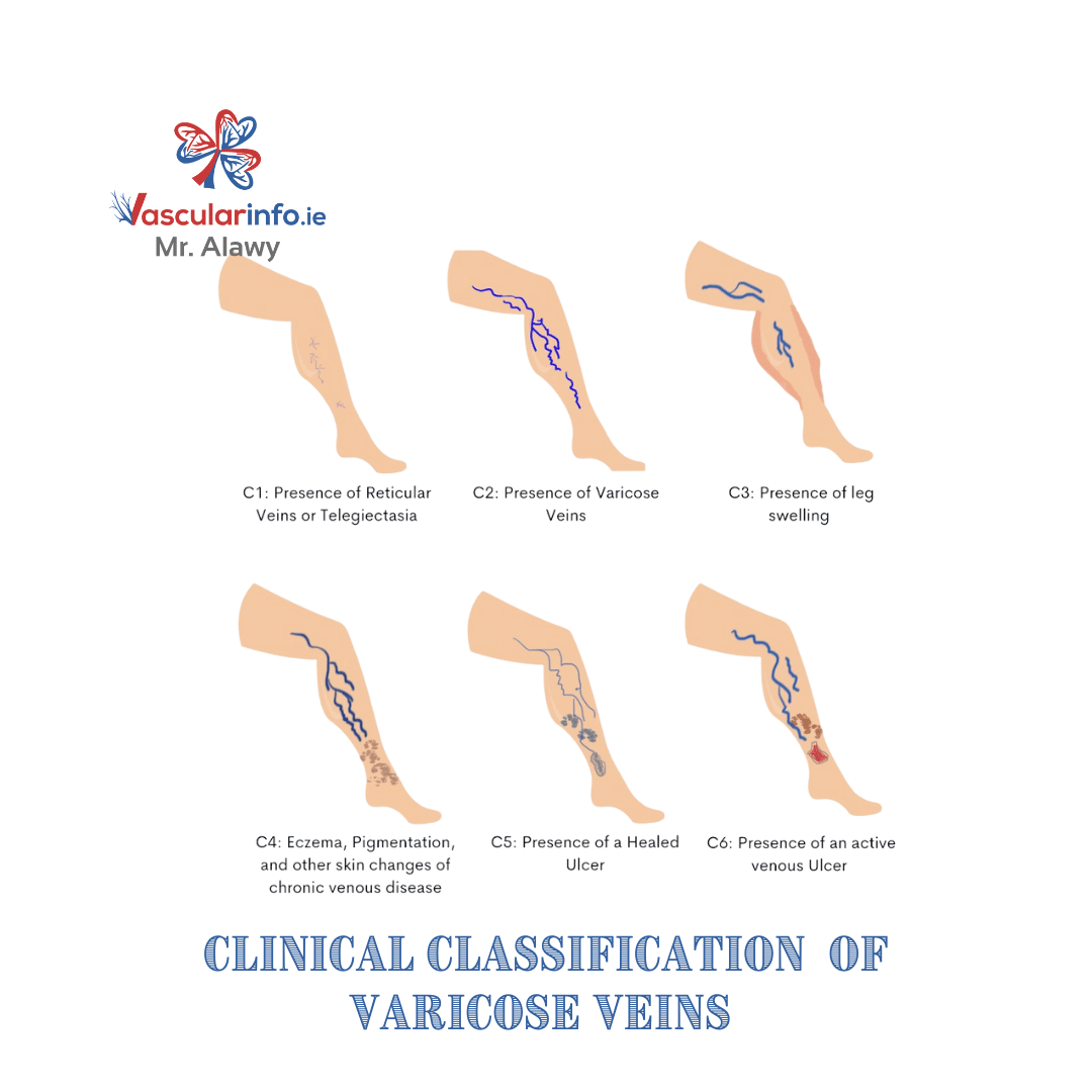 Varicose Veins & Venous Diseases