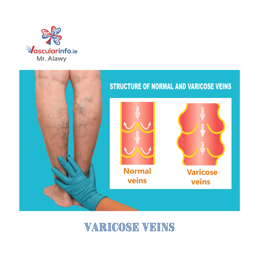 Varicose Veins & Venous Diseases