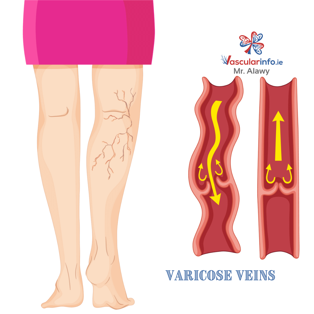 Varicose Veins & Venous Diseases
