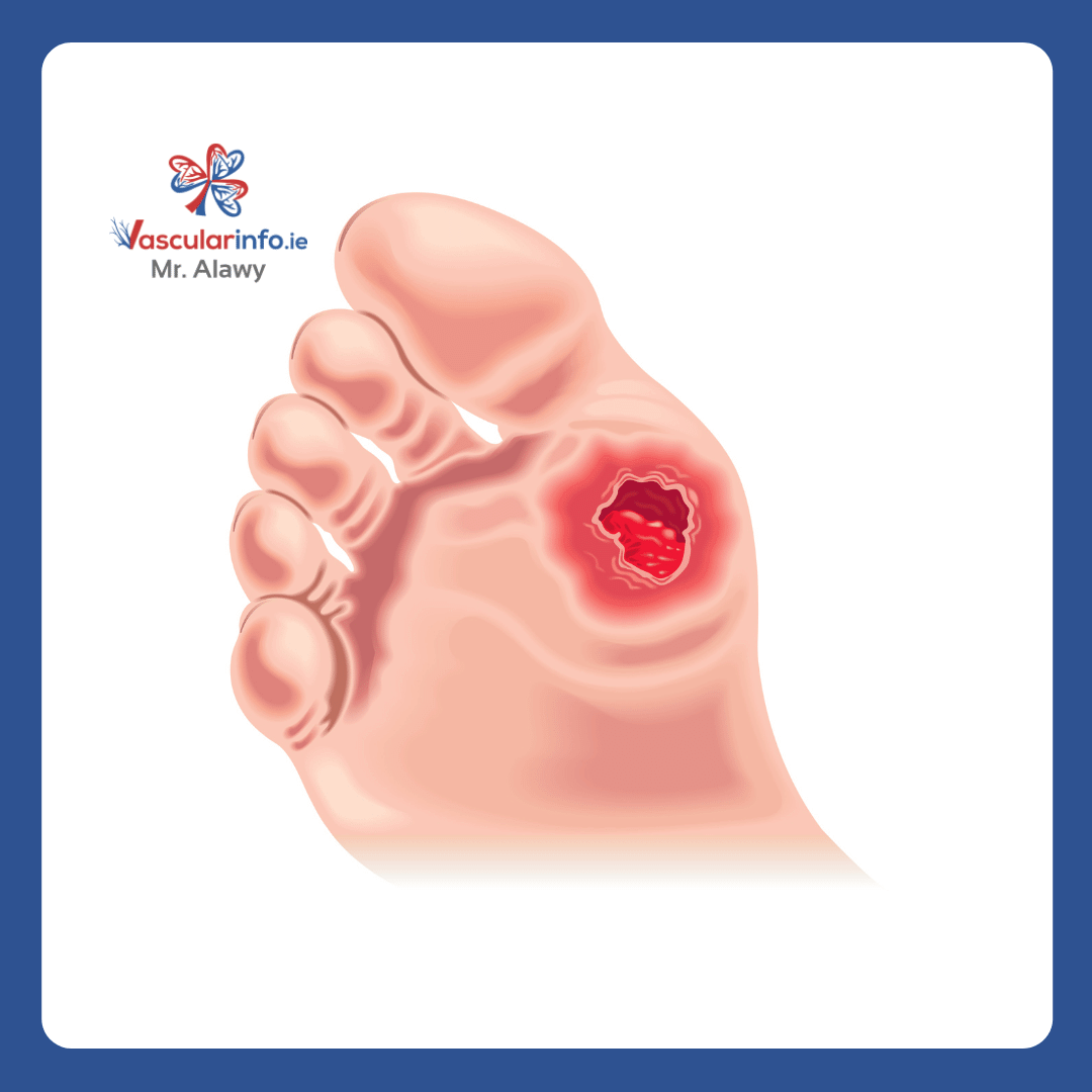 Diabetic Foot
