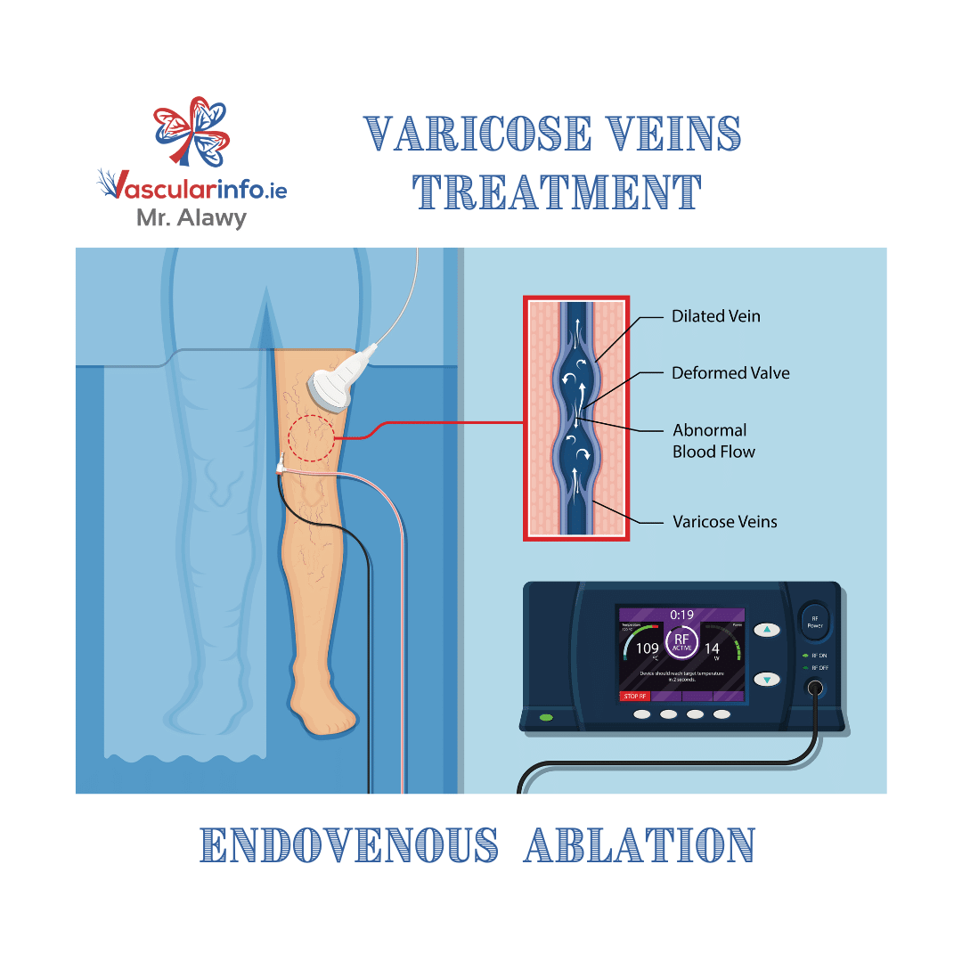 Varicose Veins & Venous Diseases