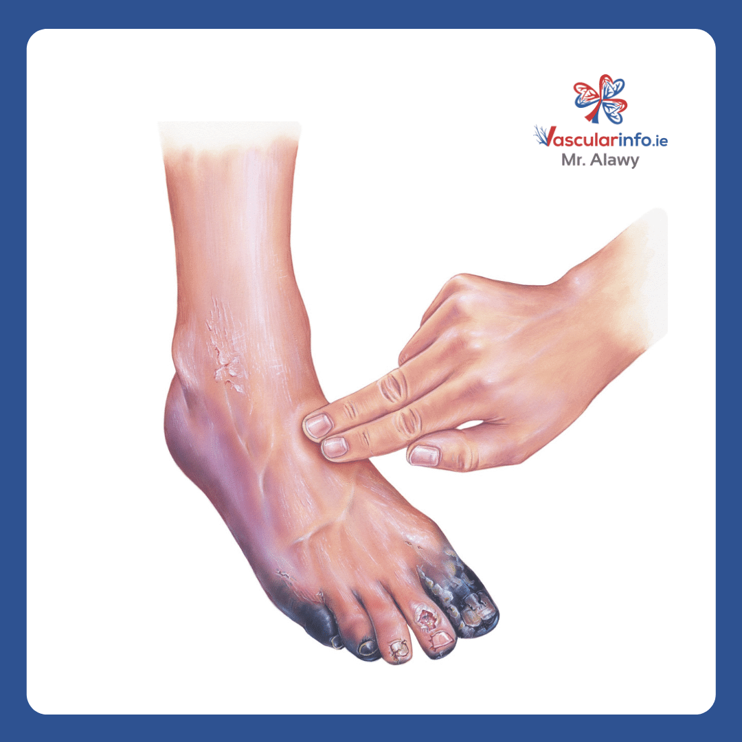 Diabetic Foot