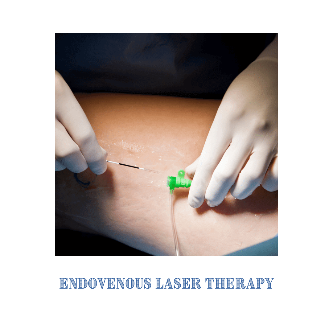 Varicose Veins Procedures