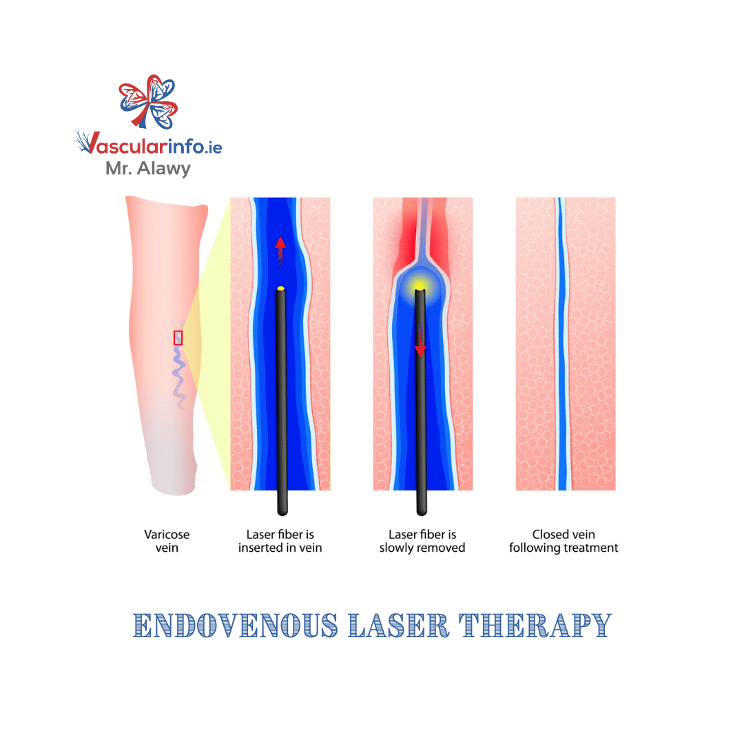 Varicose Veins Procedures