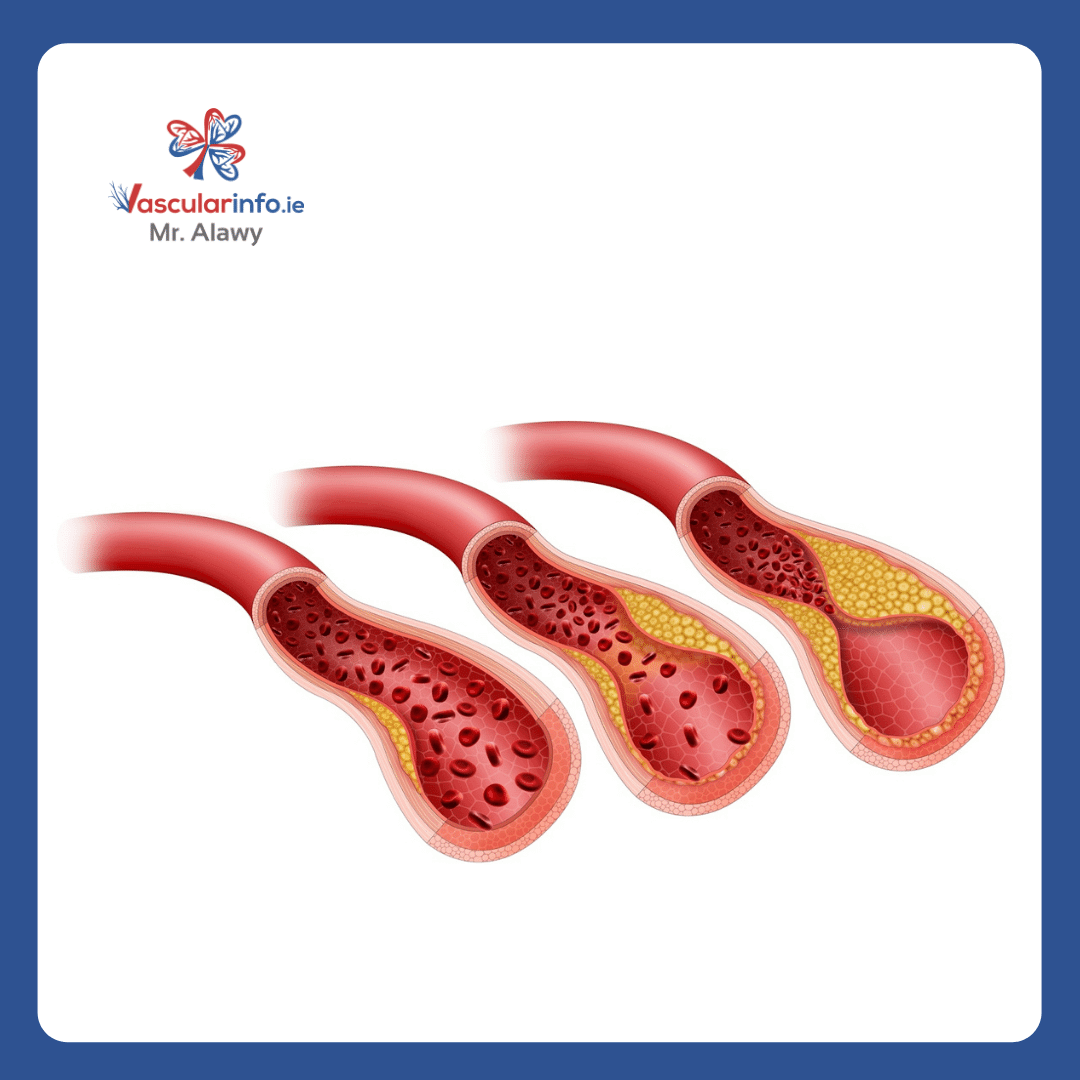 Diabetic Foot