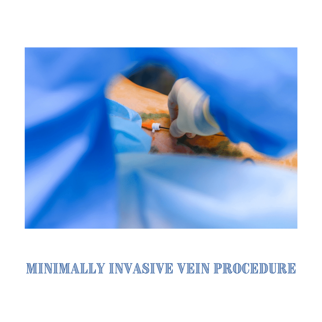 Varicose Veins Procedures