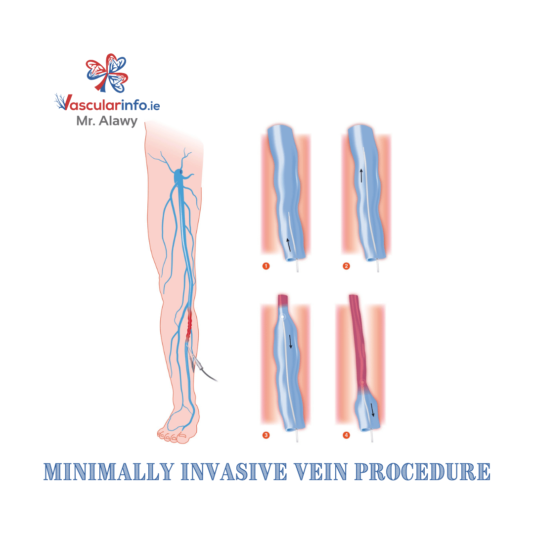 Varicose Veins Procedures