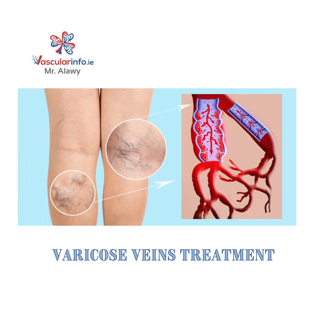 Varicose Veins Procedures