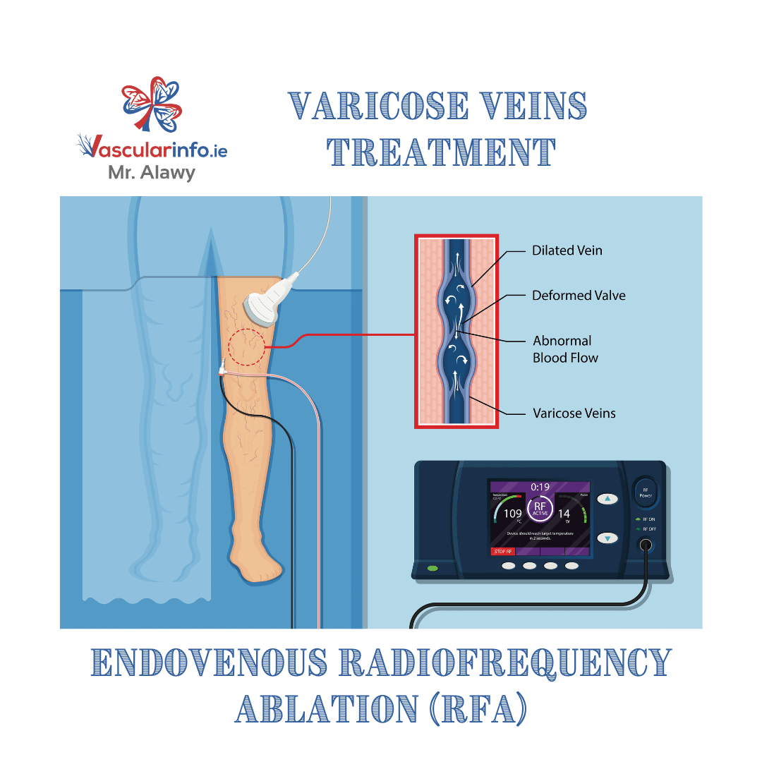 Varicose Veins Procedures