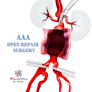 Abdominal Aortic Aneurysm(AAA) - Vascular Info