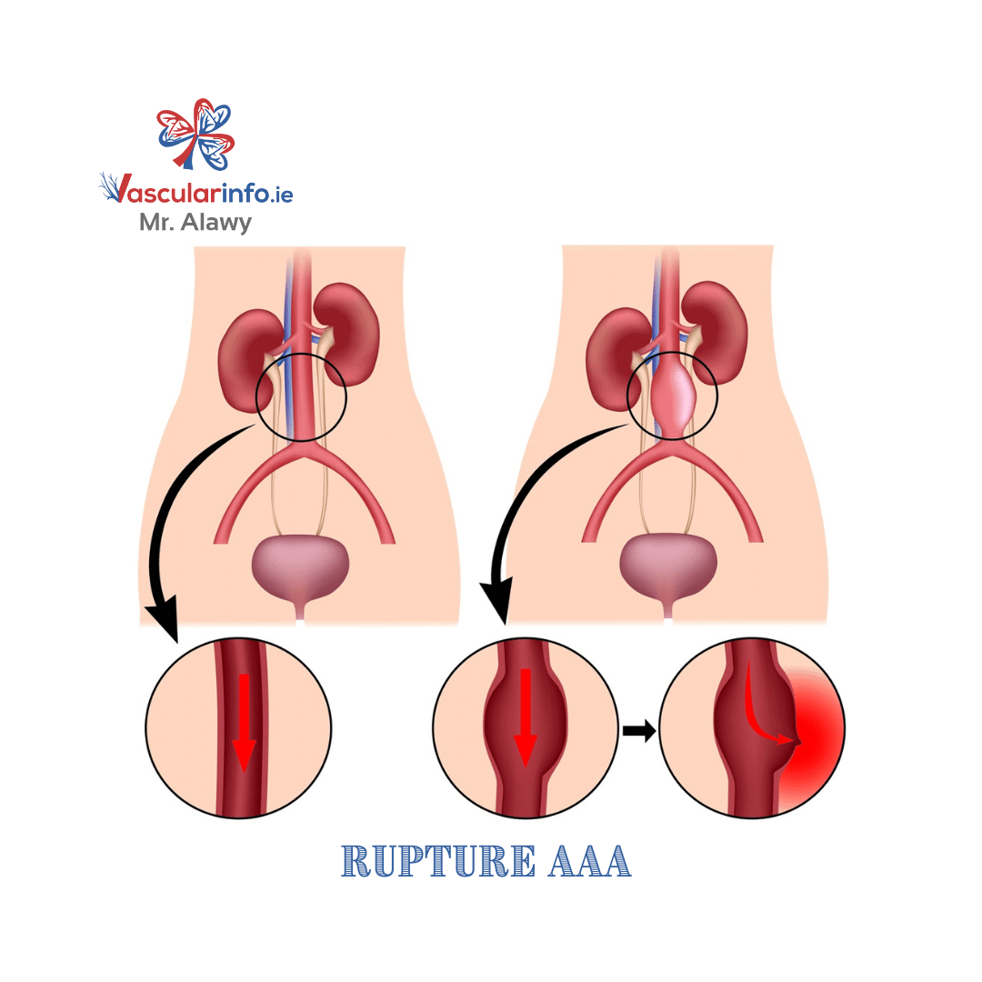 Abdominal Aortic Aneurysm(AAA)