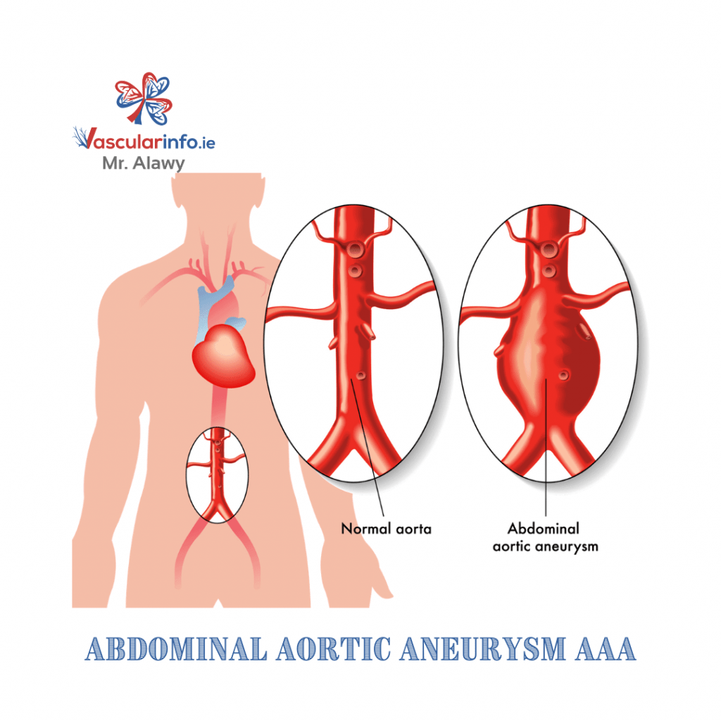 Abdominal Aortic Aneurysm(AAA) - Vascular Info