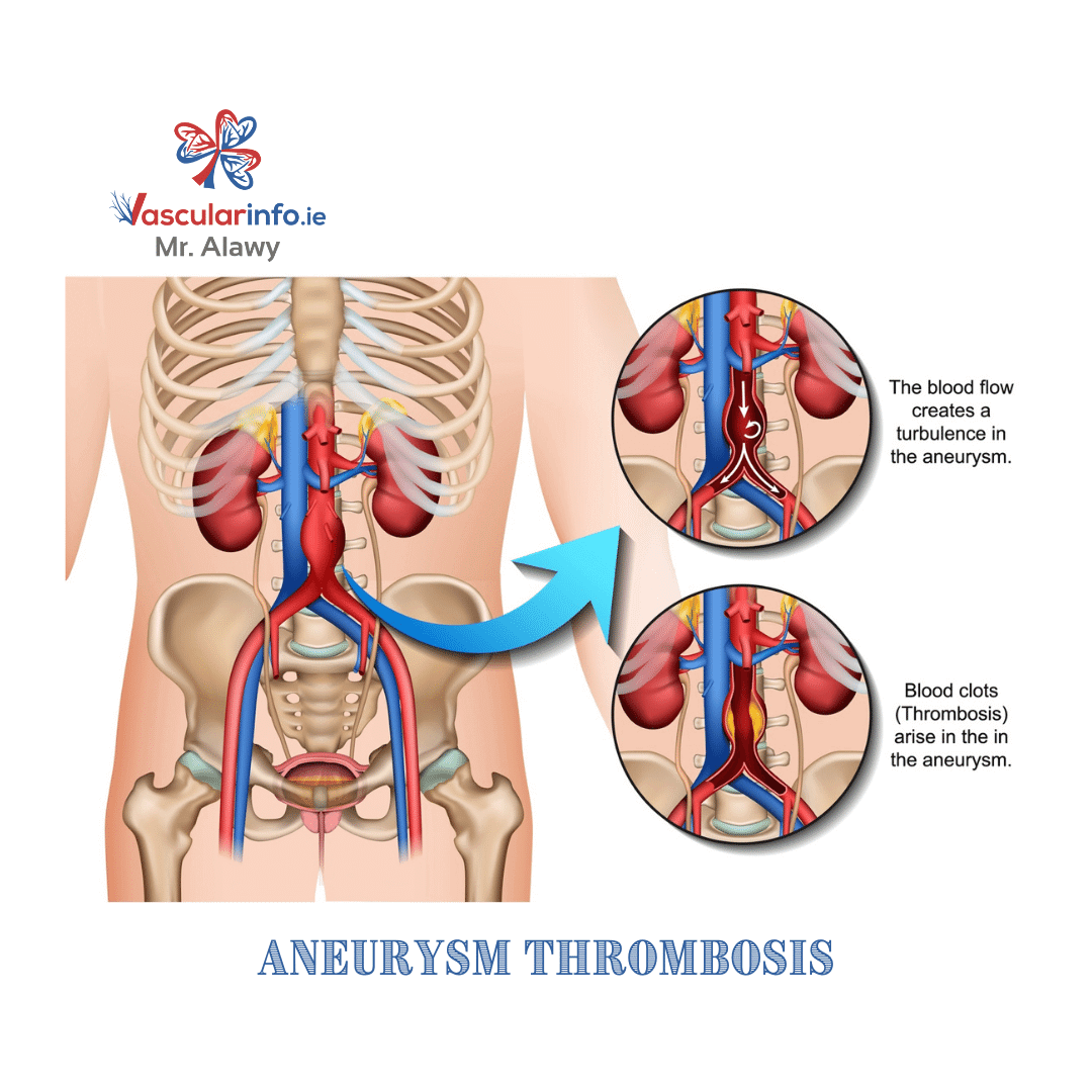 Abdominal Aortic Aneurysm(AAA)