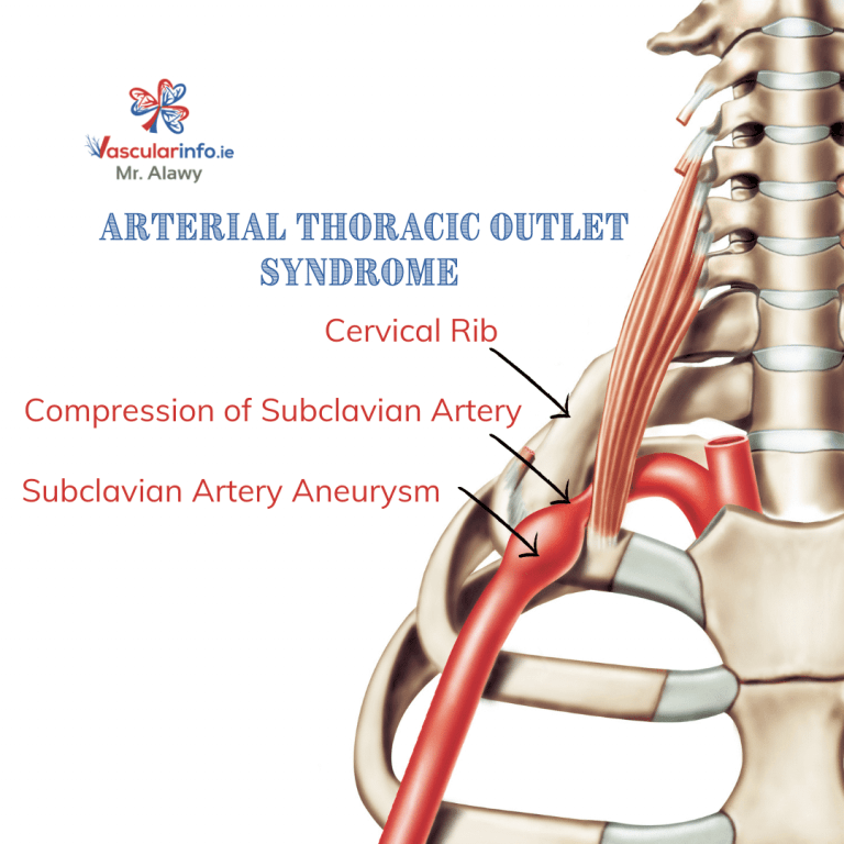 Thoracic Outlet Syndrome Vascular Info 