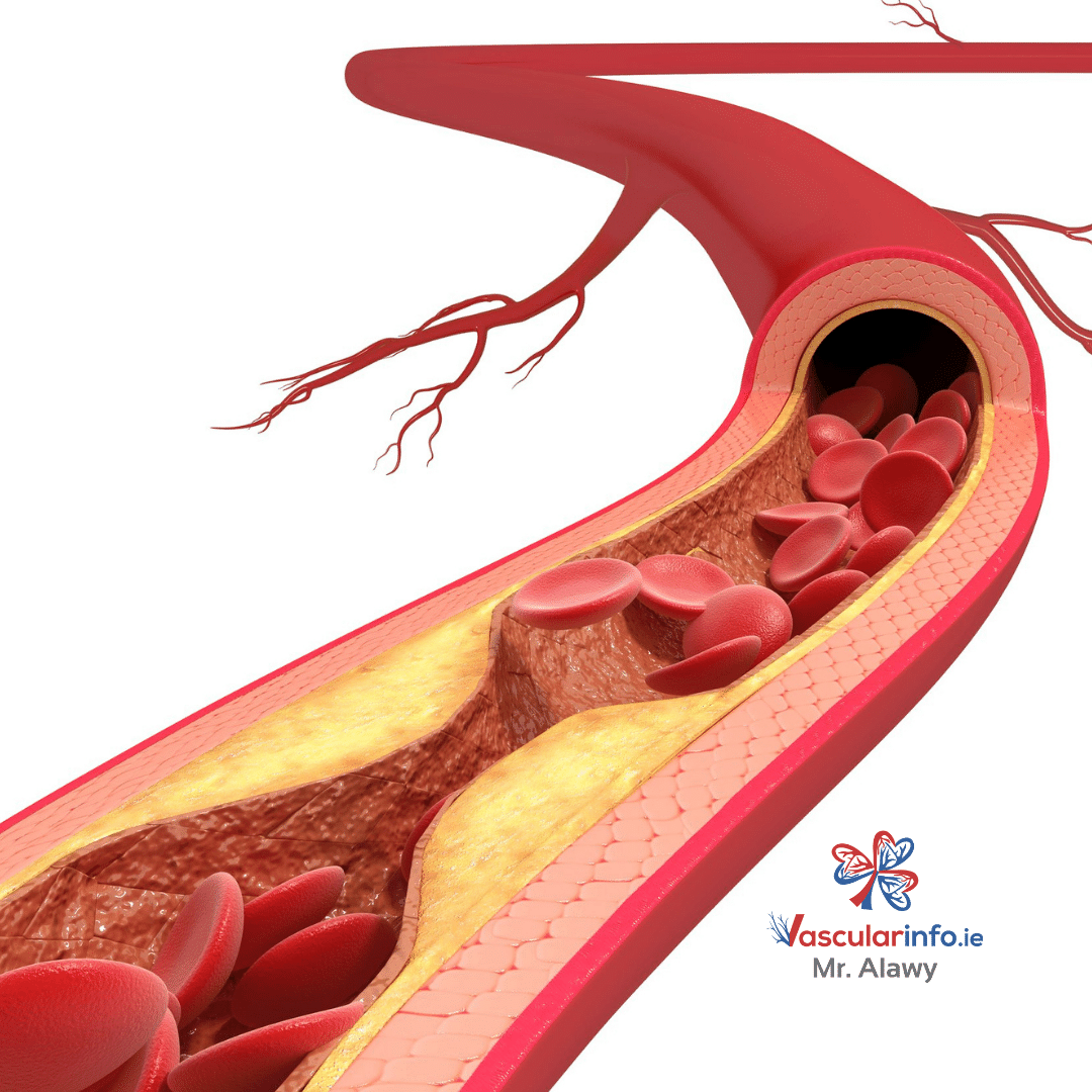 ATHEROSCLEROSIS