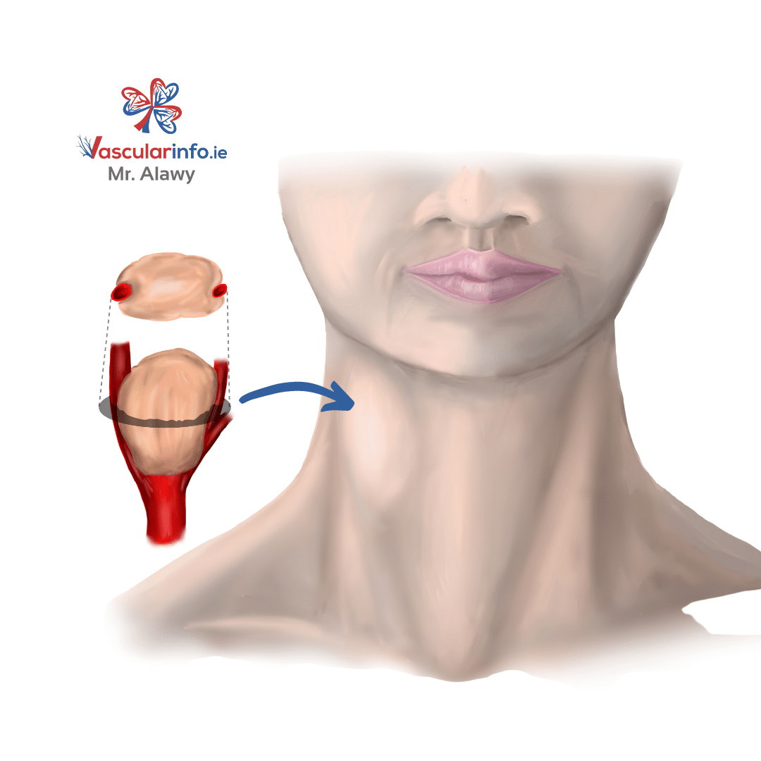 CAROTID BODY TUMOUR