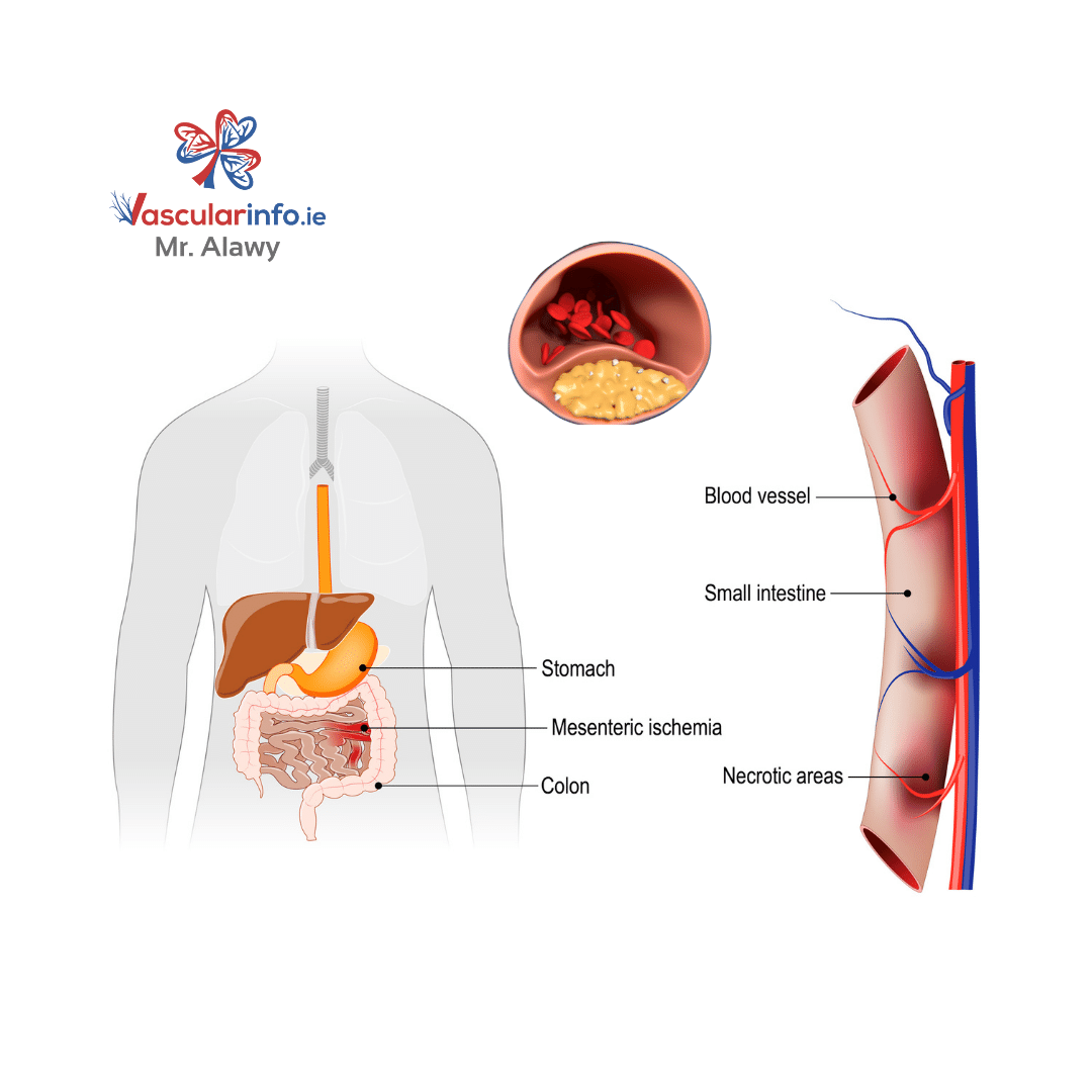 CHRONIC MESENTERIC ISCHEMIA