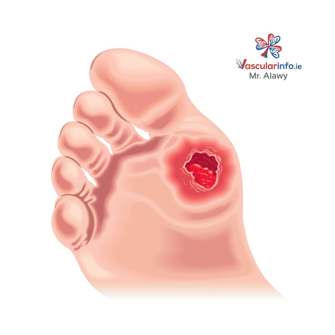 DIABETIC FOOT