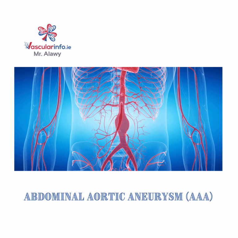 Abdominal Aortic Aneurysm(AAA) - Vascular Info
