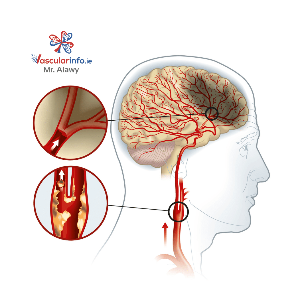 STROKE & CAROTID ARTERY DISEASE