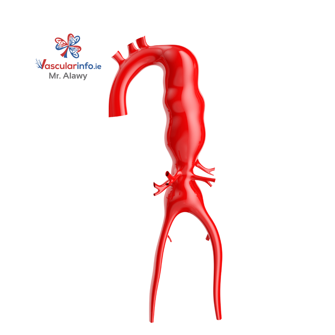 THORACOABDOMINAL AORTIC ANEURYSMS