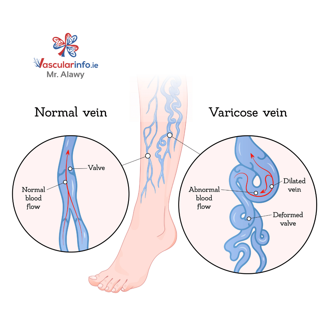 VARICOSE VEINS