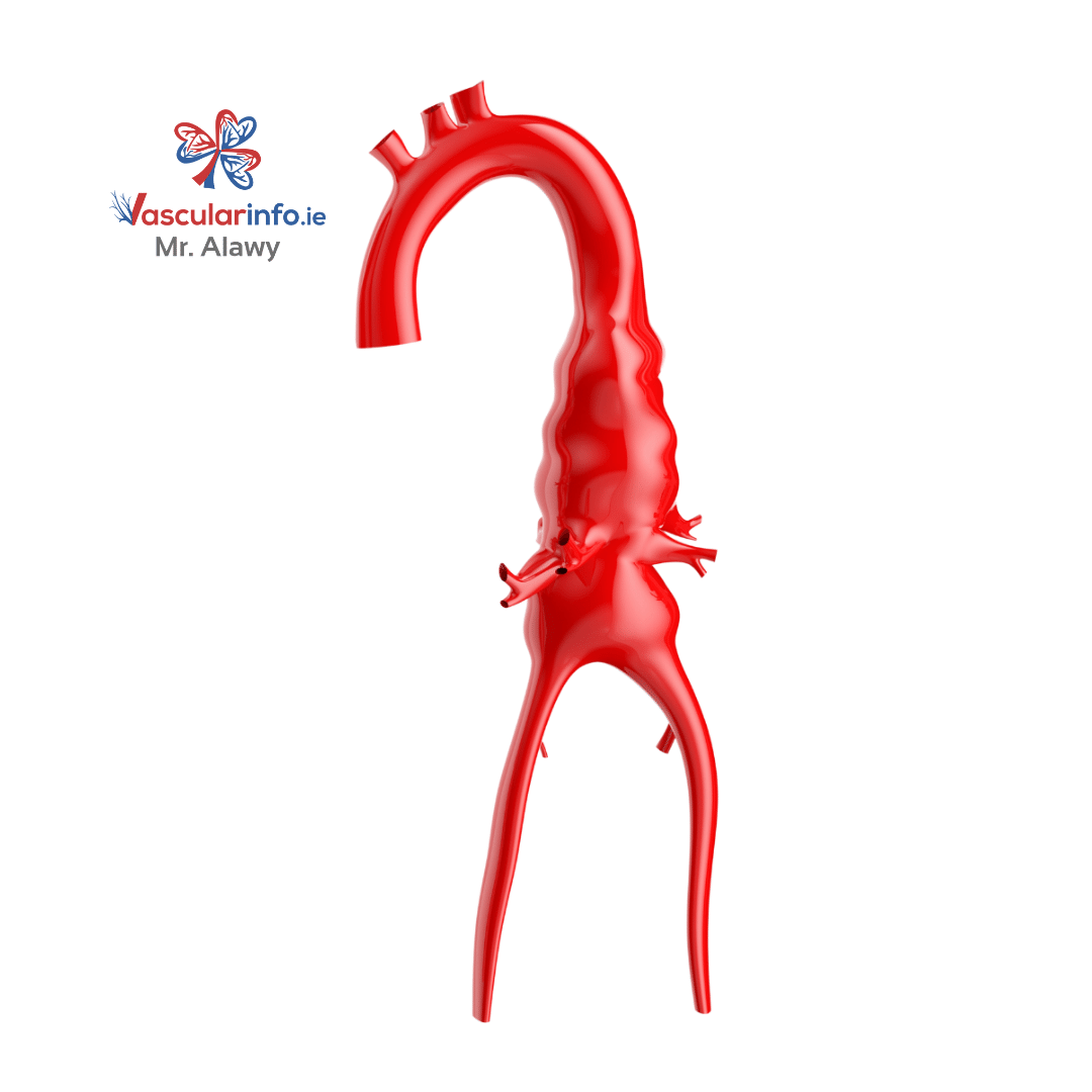 Complex Endovascular Repair of Aortic Aneurysms