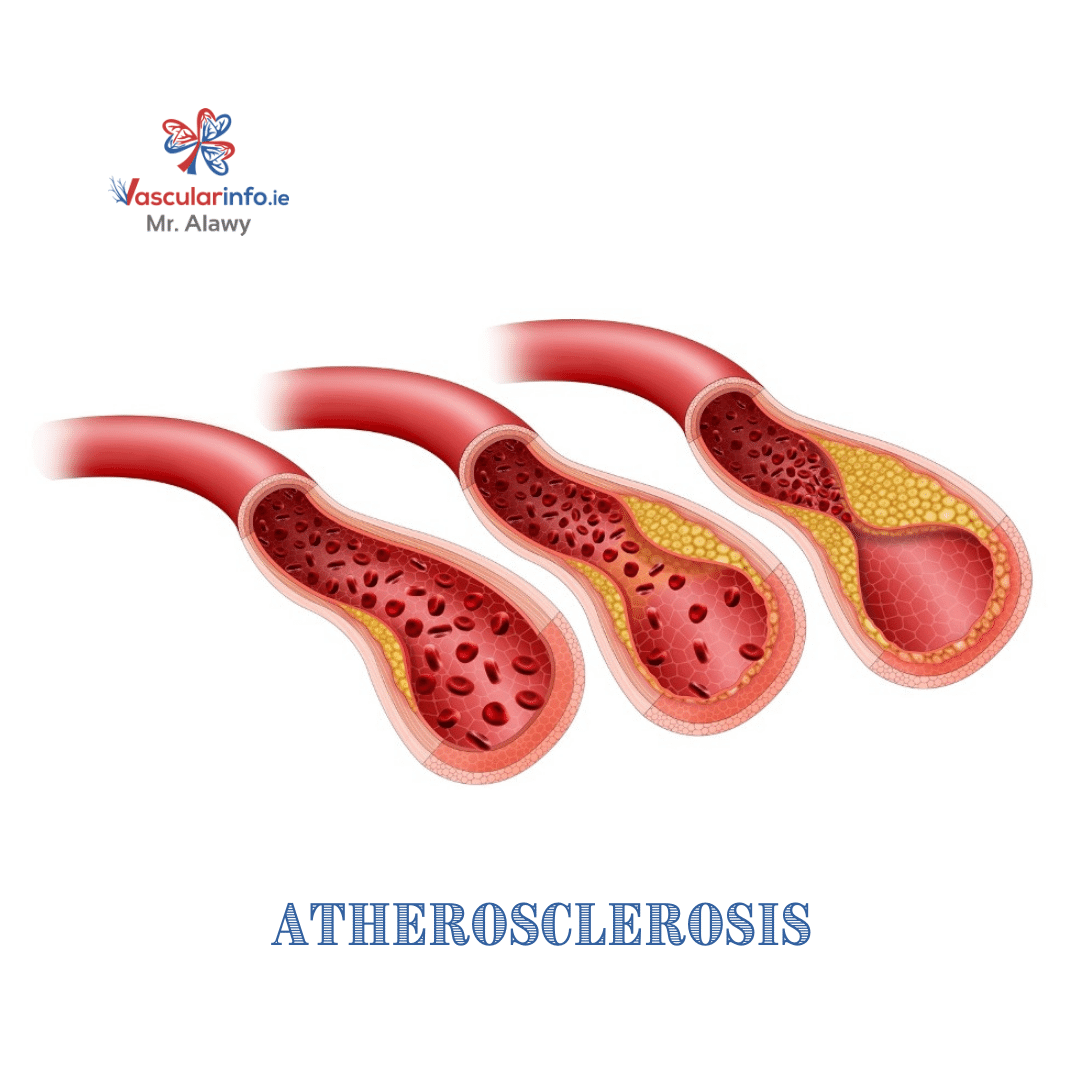 Peripheral Arterial Disease