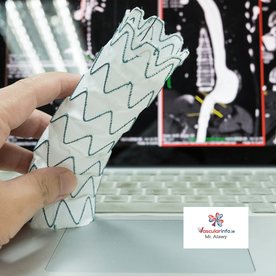 Thoracic Aortic Aneurysm