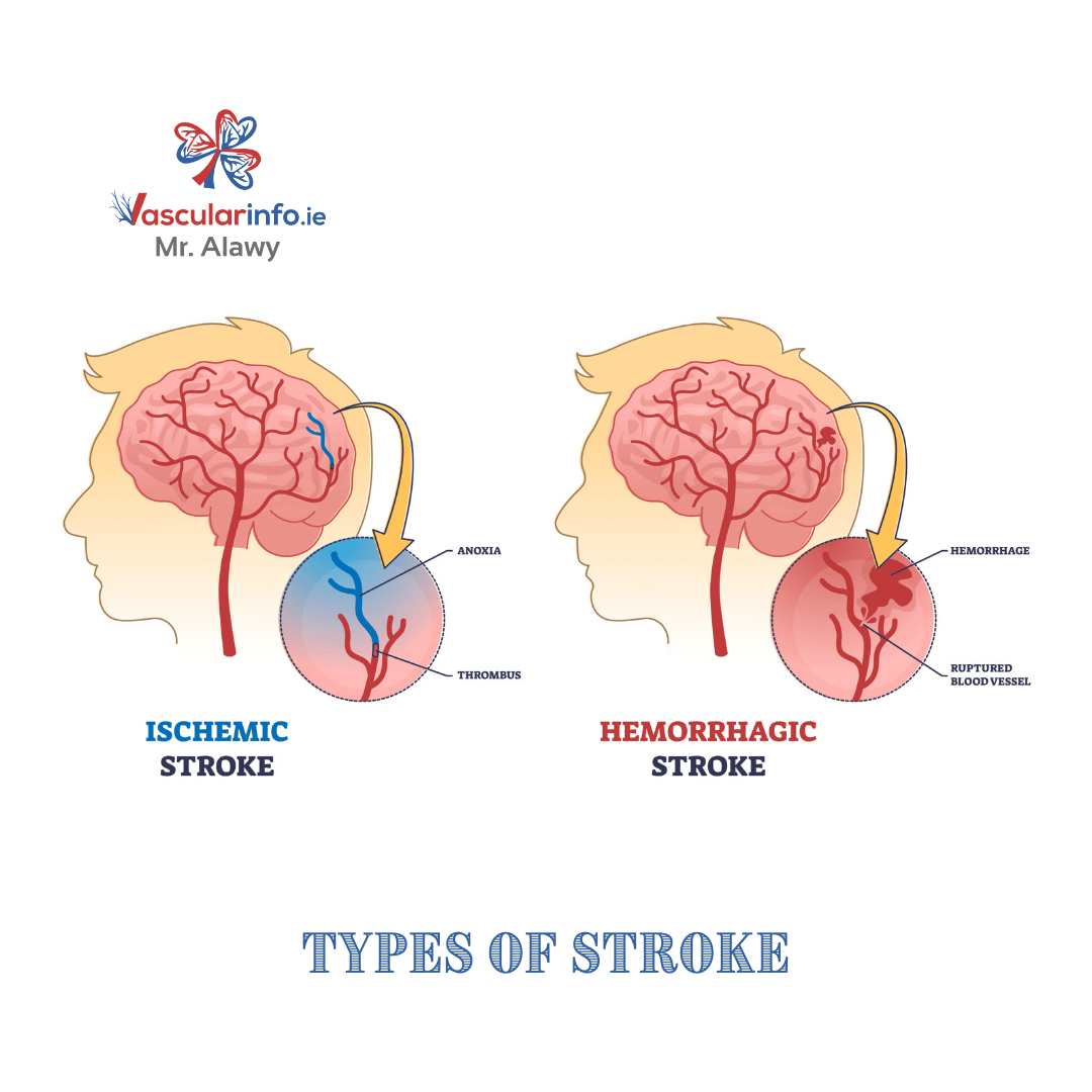 Stroke