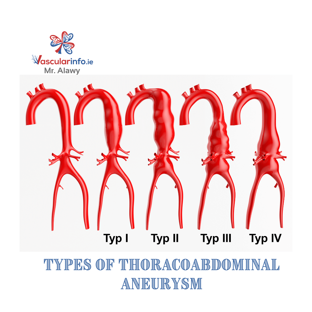 Complex Endovascular Repair of Aortic Aneurysms