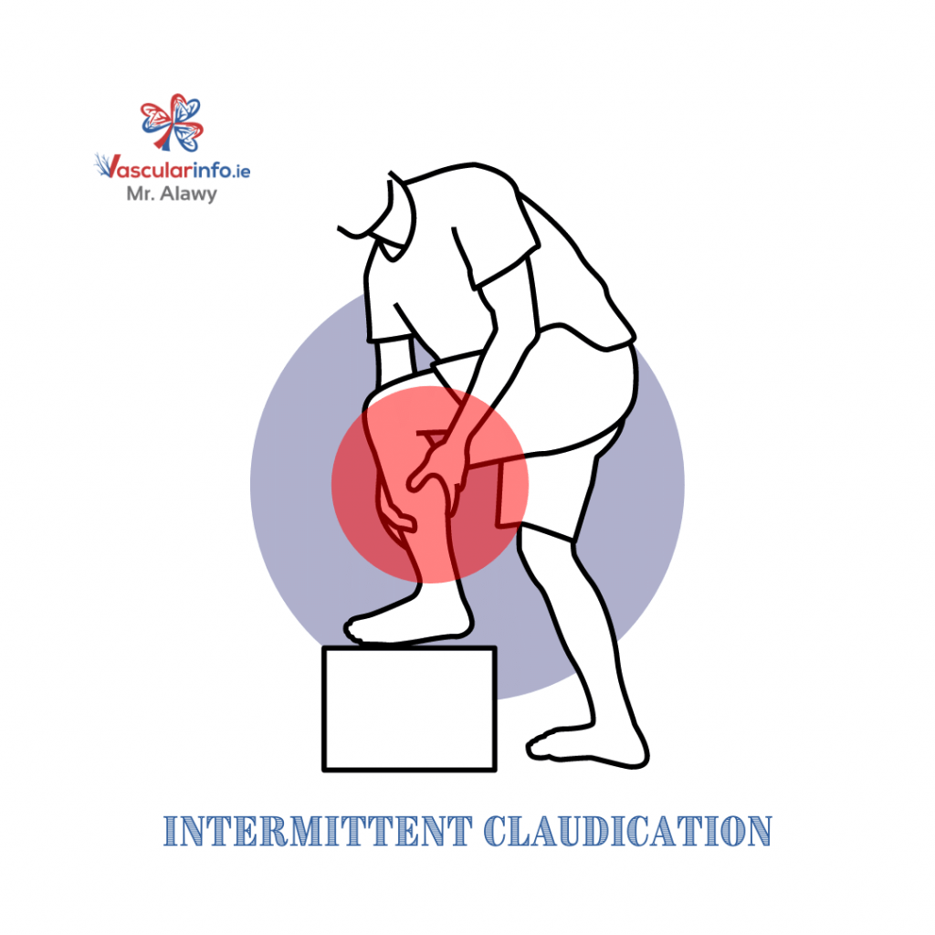 Peripheral Arterial Disease