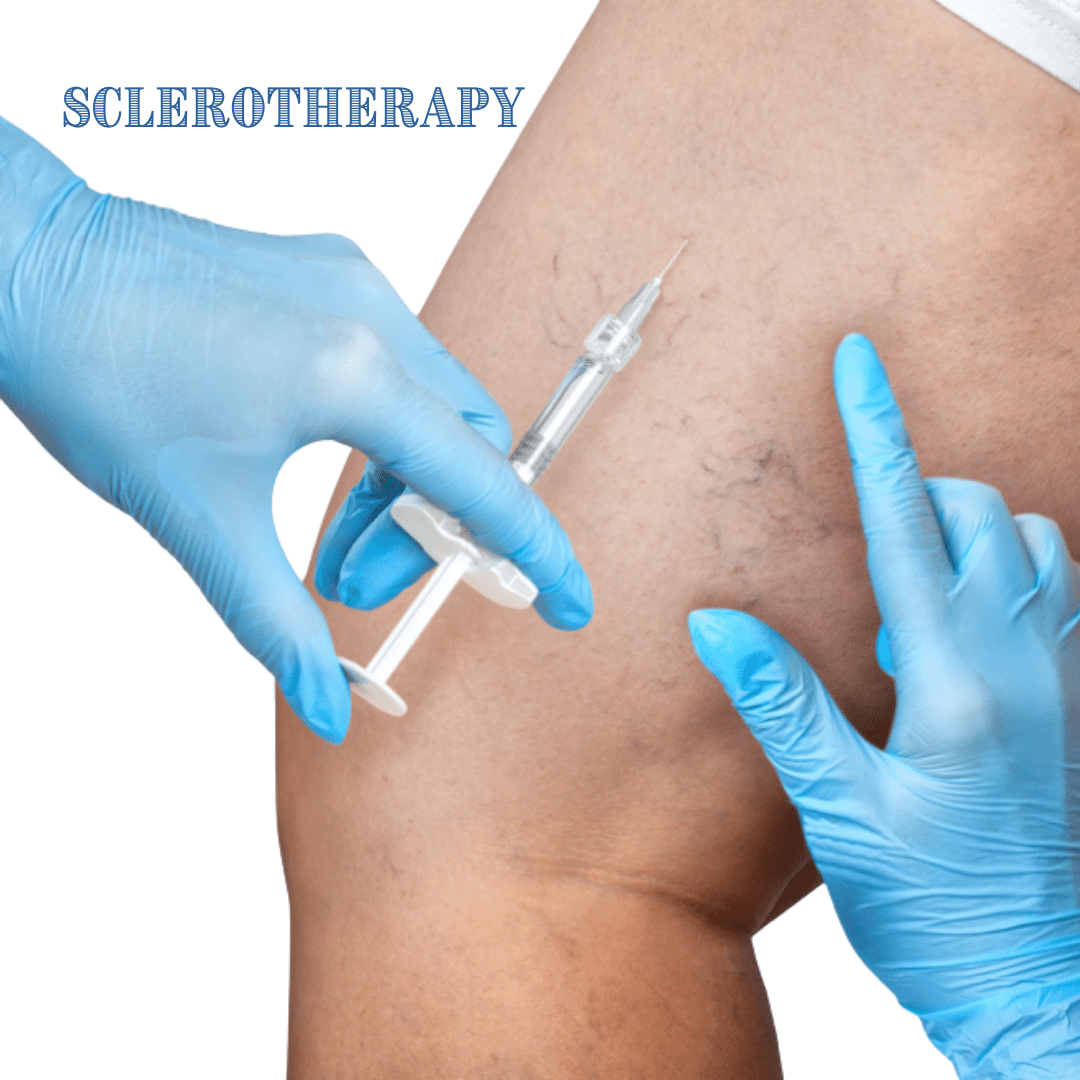 Varicose Veins Procedures