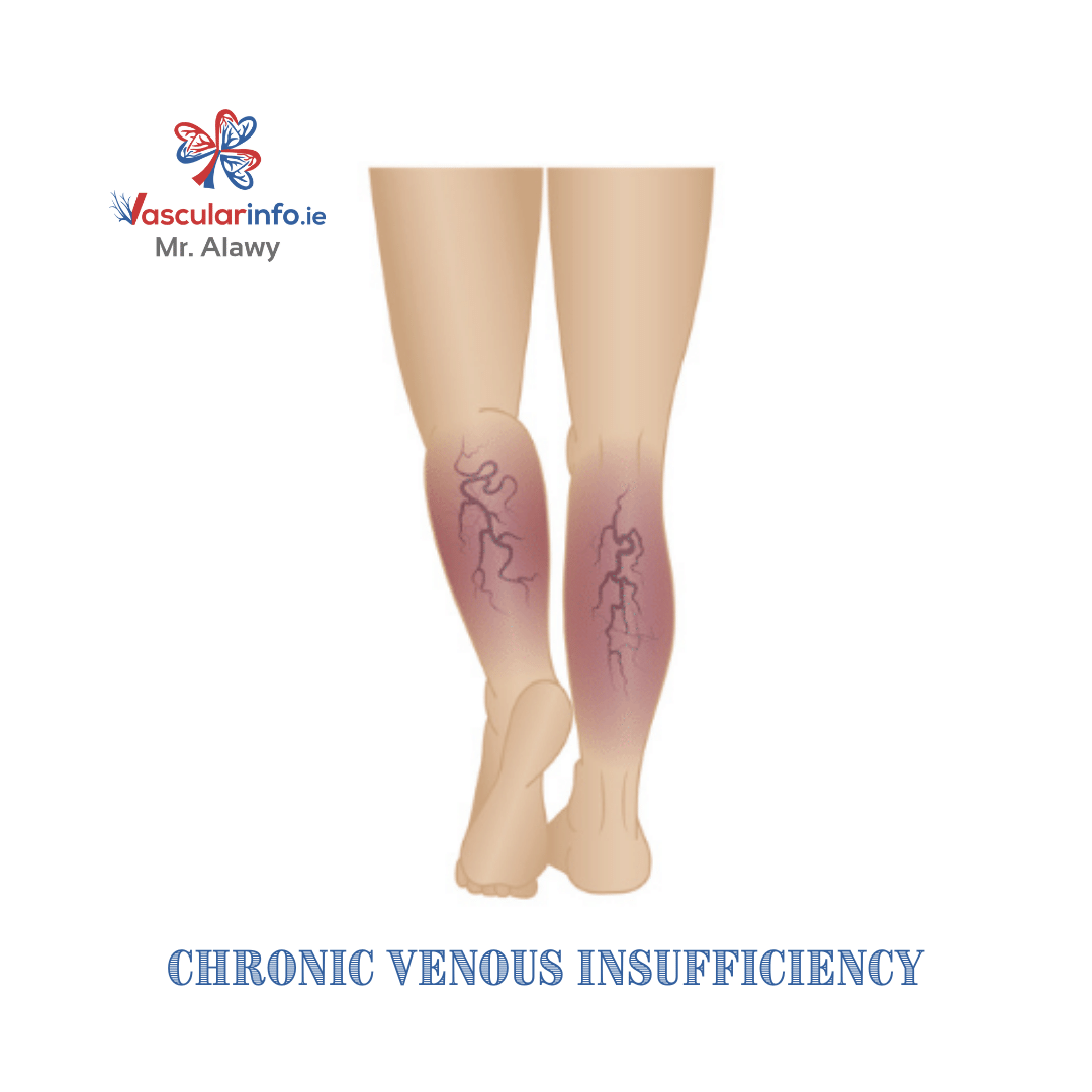 Varicose Veins Procedures