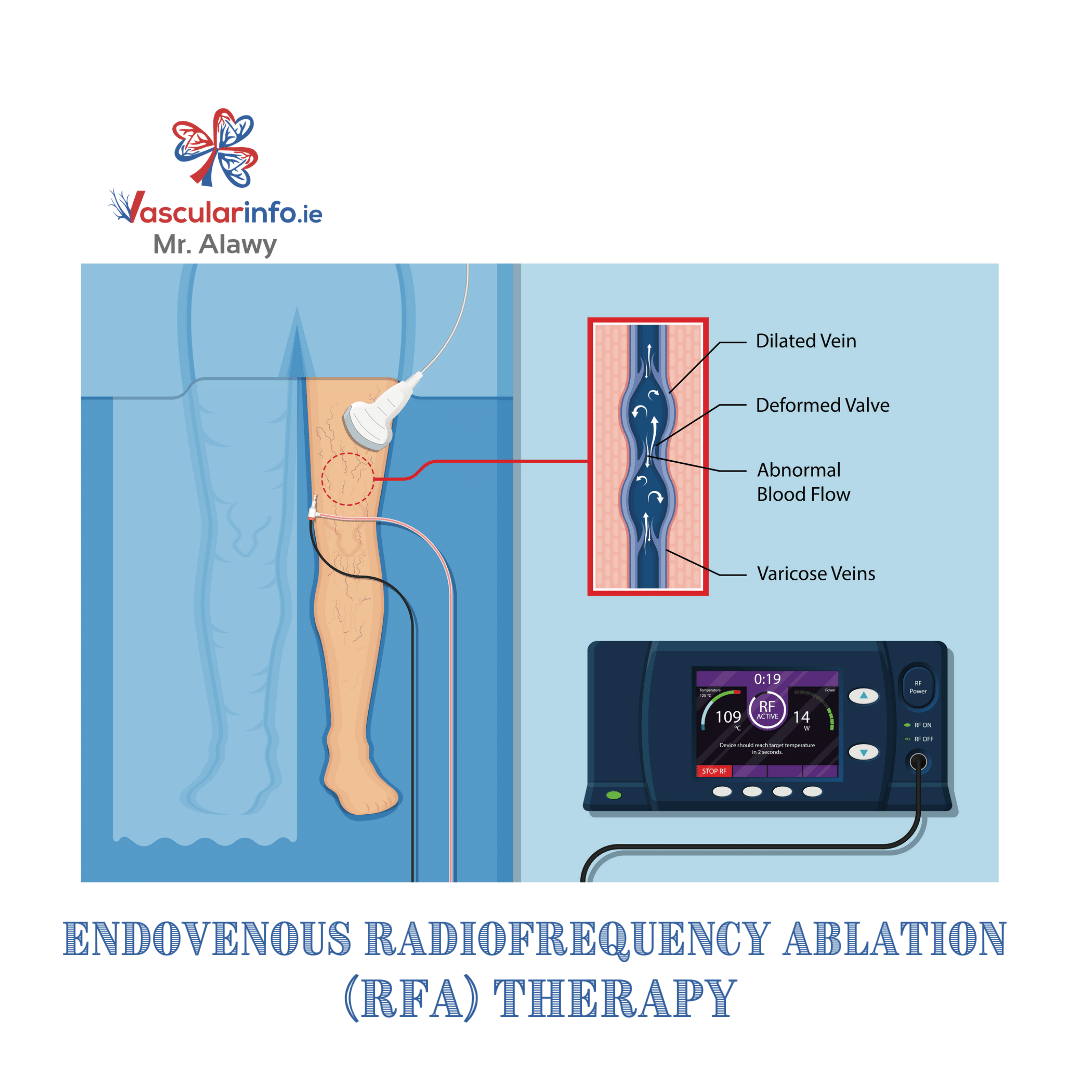 Varicose Veins Procedures