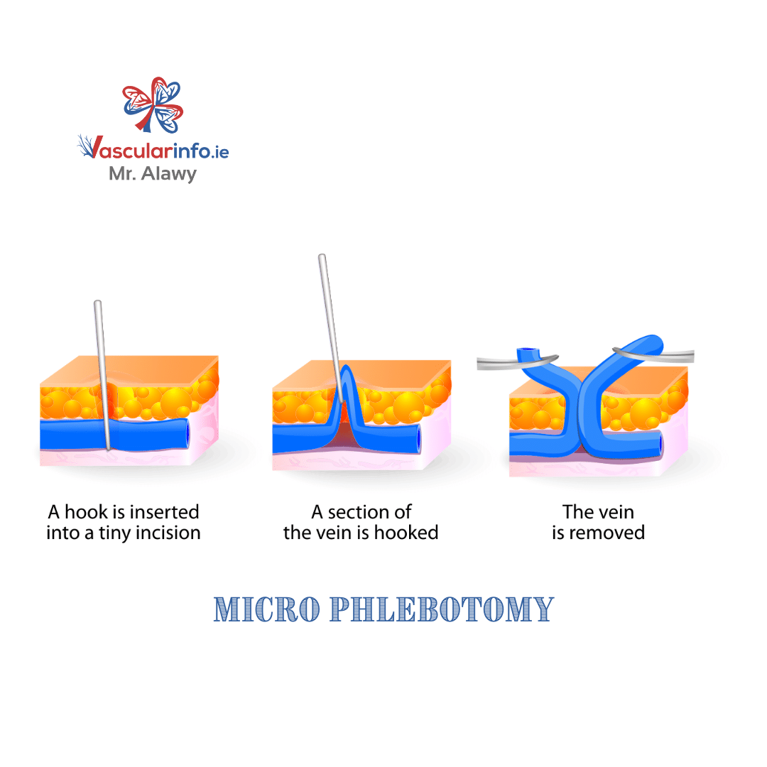 Varicose Veins Procedures