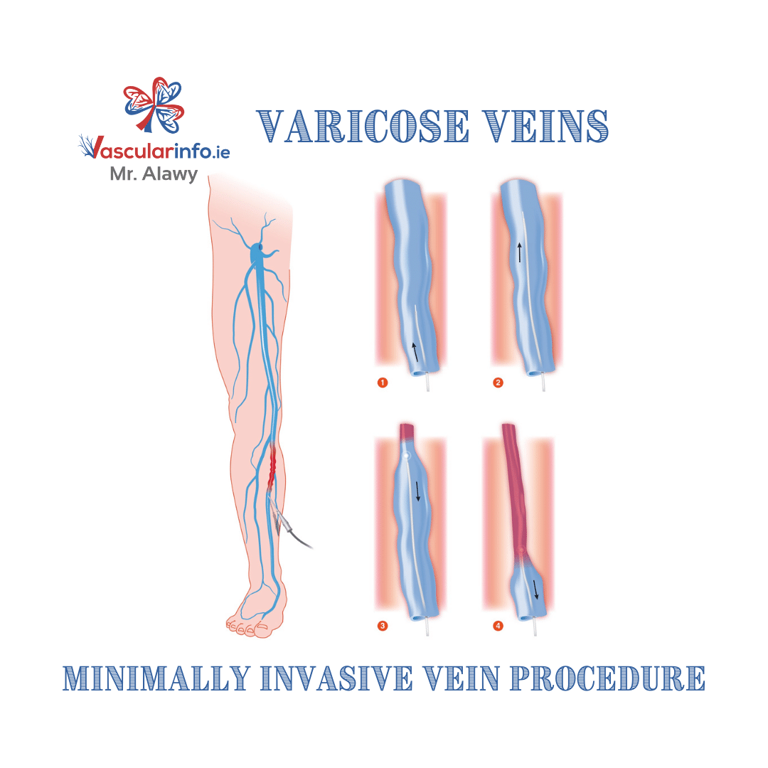 Varicose Veins Surgery
