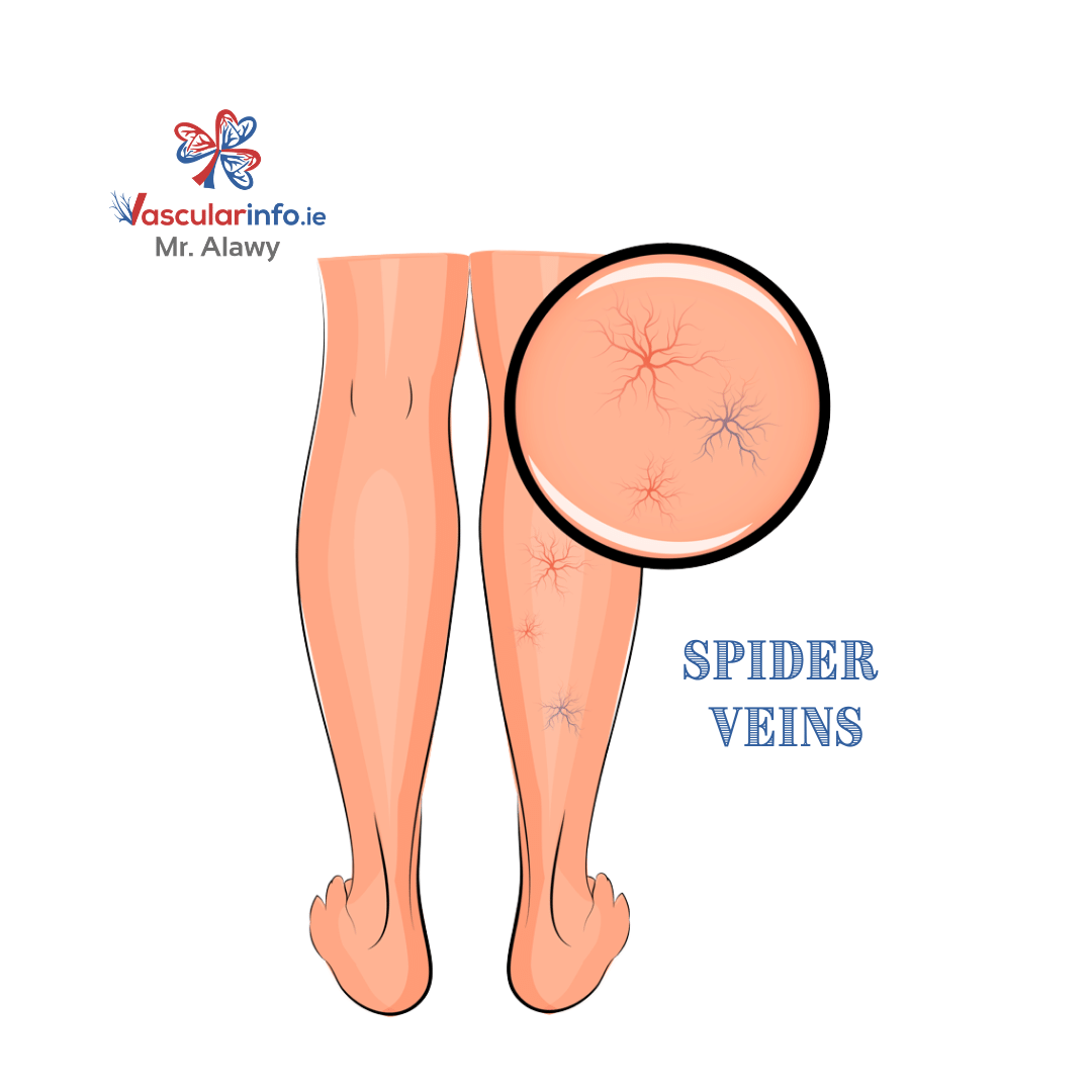 Varicose Veins Procedures