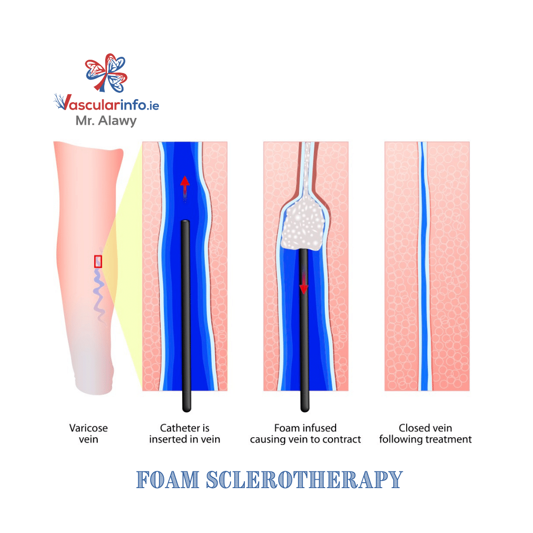 Varicose Veins Procedures
