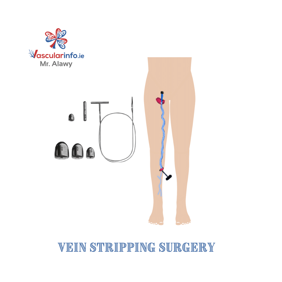 Varicose Veins Procedures
