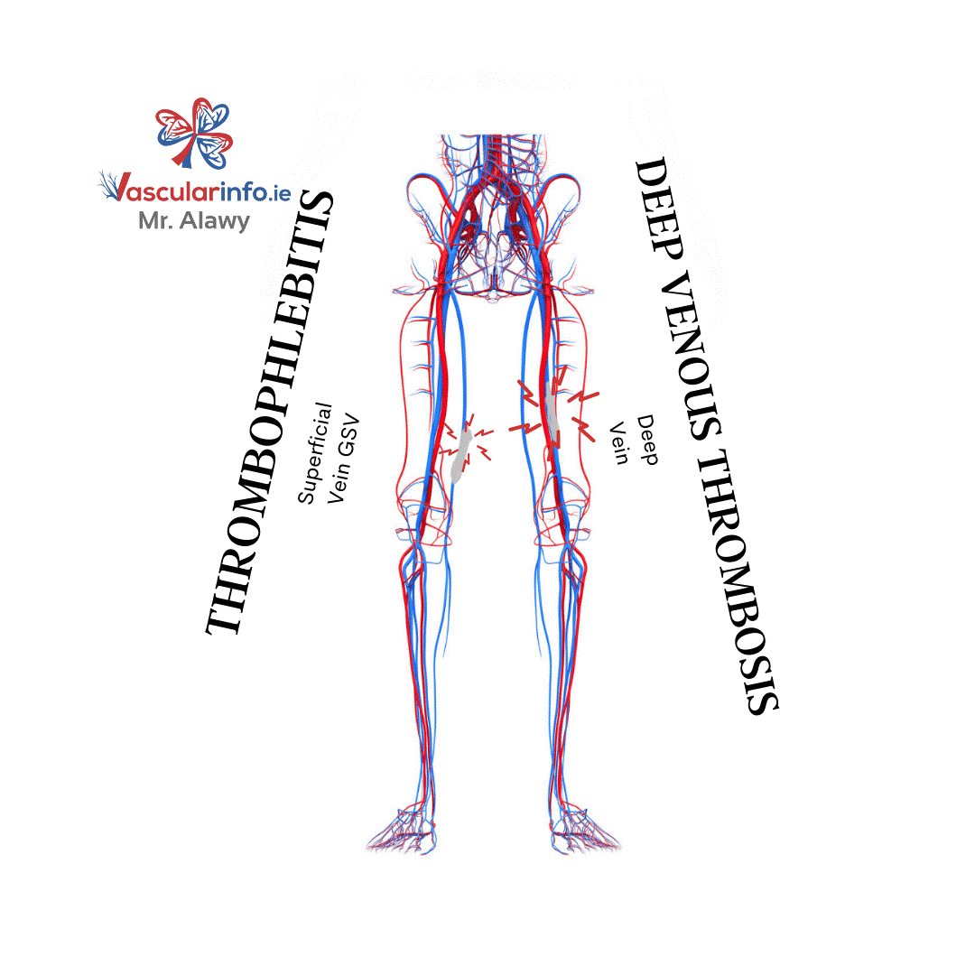 Varicose Veins Procedures