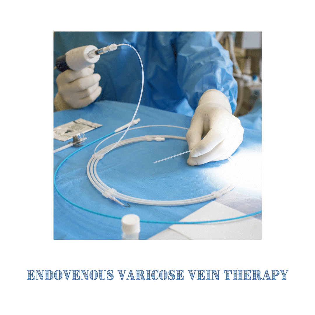 Varicose Veins Procedures