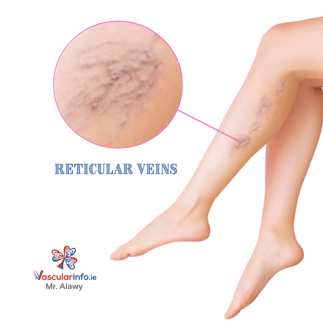 Varicose Veins Procedures